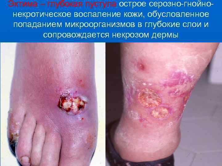 Эктима – глубокая пустула острое серозно-гнойнонекротическое воспаление кожи, обусловленное попаданием микроорганизмов в глубокие слои