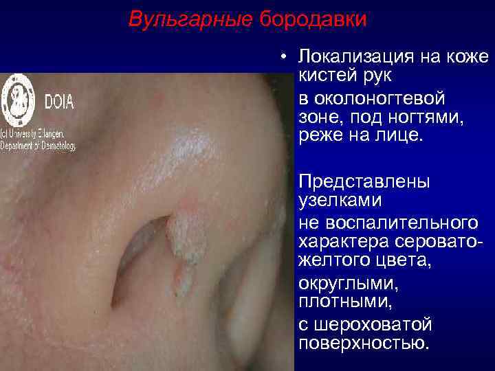 Вульгарные бородавки • Локализация на коже кистей рук • в околоногтевой зоне, под ногтями,
