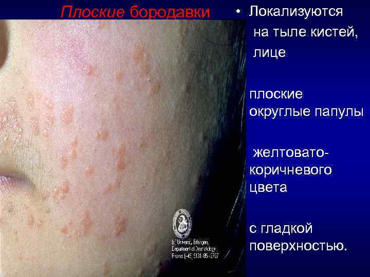 Плоские бородавки • Локализуются • на тыле кистей, • лице • плоские округлые папулы
