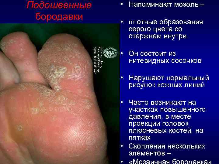 Подошвенные бородавки • Напоминают мозоль – • плотные образования серого цвета со стержнем внутри.