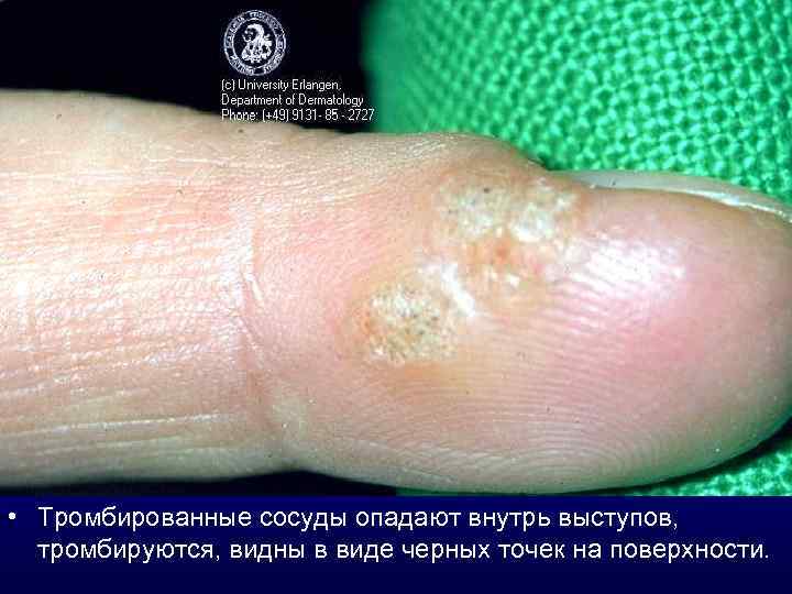  • Тромбированные сосуды опадают внутрь выступов, тромбируются, видны в виде черных точек на