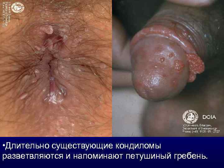  • Длительно существующие кондиломы разветвляются и напоминают петушиный гребень. 