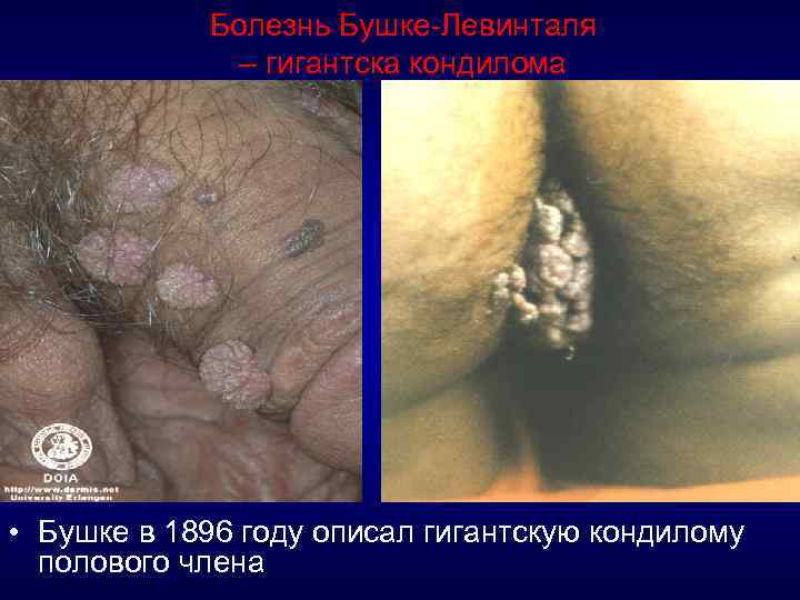 Болезнь Бушке-Левинталя – гигантска кондилома • Бушке в 1896 году описал гигантскую кондилому полового
