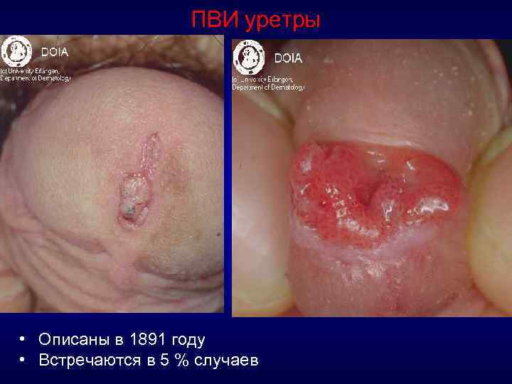 ПВИ уретры • Описаны в 1891 году • Встречаются в 5 % случаев 