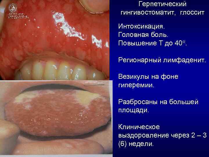 Герпетический гингивостоматит, глоссит Интоксикация. Головная боль. Повышение Т до 40. Регионарный лимфаденит. Везикулы на