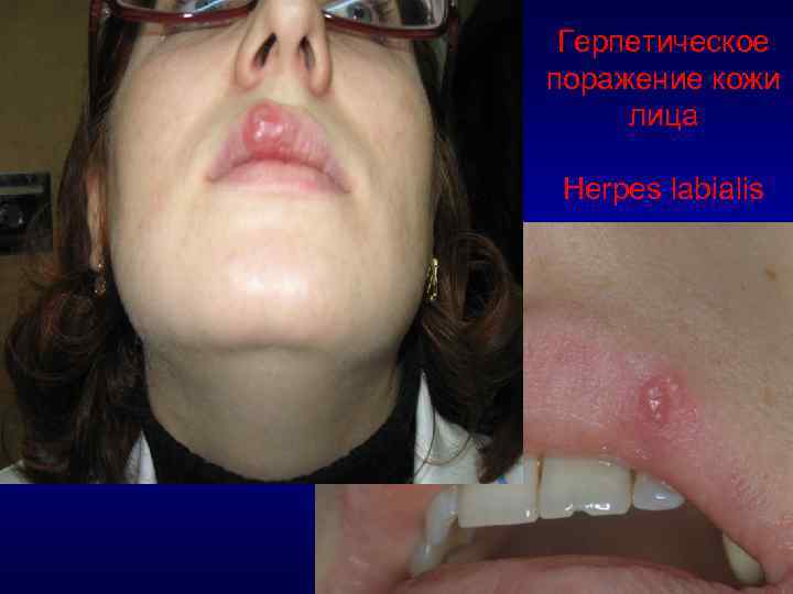 Герпетическое поражение кожи лица Herpes labialis 