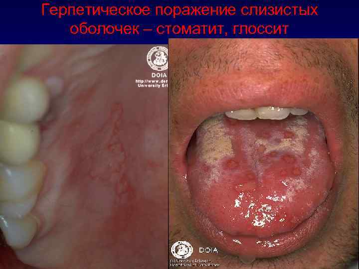 Герпетическое поражение слизистых оболочек – стоматит, глоссит 