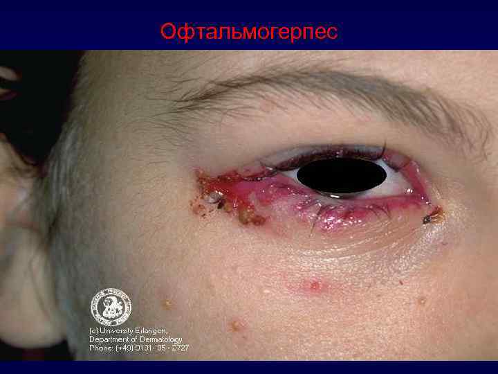 Офтальмогерпес 