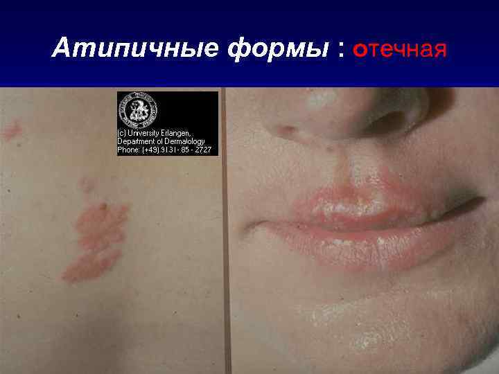 Атипичные формы : отечная 