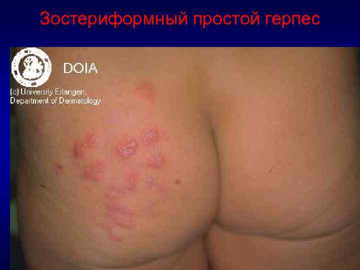 Зостериформный простой герпес 