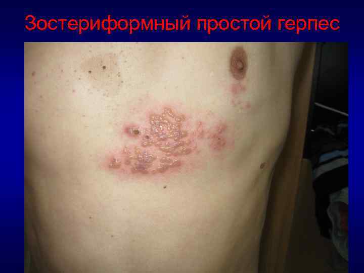 Зостериформный простой герпес 