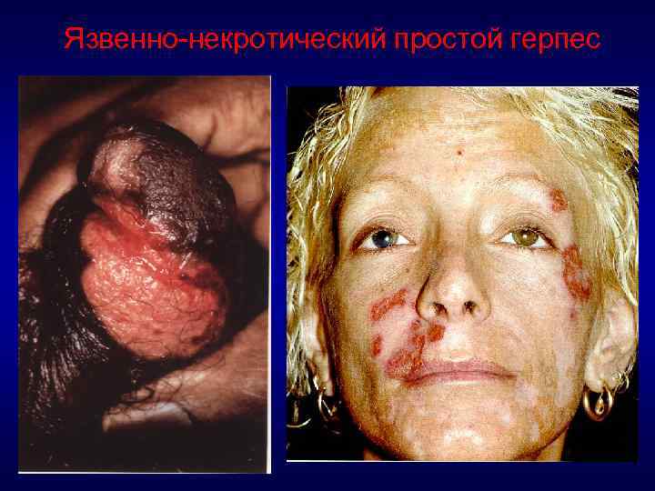 Язвенно-некротический простой герпес 