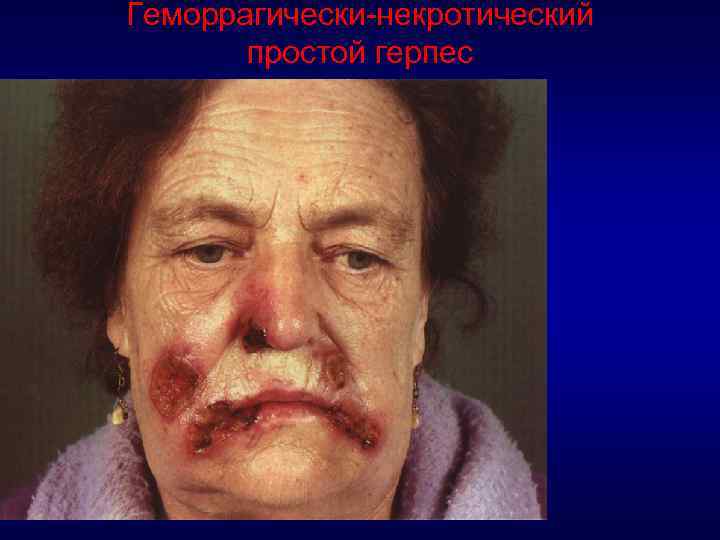 Геморрагически-некротический простой герпес 