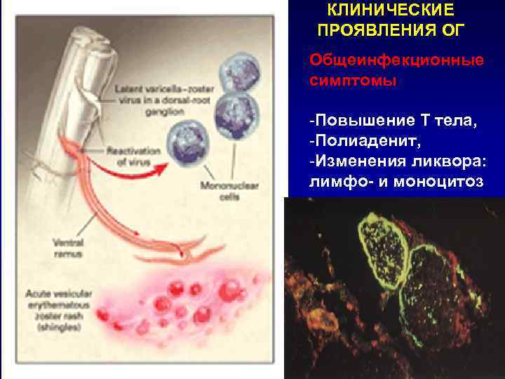 КЛИНИЧЕСКИЕ ПРОЯВЛЕНИЯ ОГ Общеинфекционные симптомы -Повышение Т тела, -Полиаденит, -Изменения ликвора: лимфо- и моноцитоз