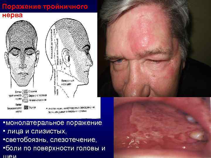 Поражение тройничного нерва • монолатеральное поражение • лица и слизистых, • светобоязнь, слезотечение, •