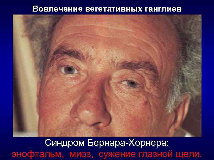 Вовлечение вегетативных ганглиев Синдром Бернара-Хорнера: энофтальм, миоз, сужение глазной щели. 