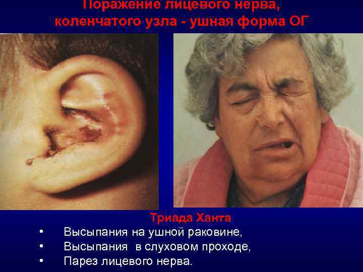 Поражение лицевого нерва, коленчатого узла - ушная форма ОГ • • • Триада Ханта