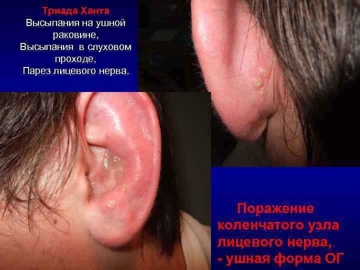 Триада Ханта Высыпания на ушной раковине, Высыпания в слуховом проходе, Парез лицевого нерва. Поражение