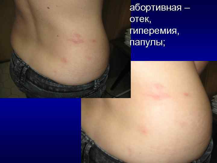 абортивная – отек, гиперемия, папулы; 