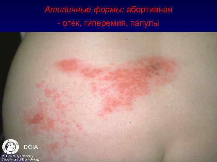 Атипичные формы: абортивная - отек, гиперемия, папулы 