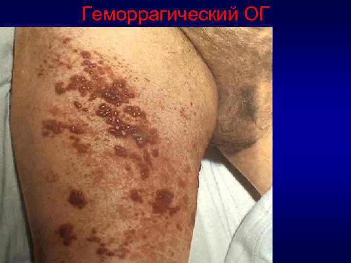 Геморрагический ОГ 