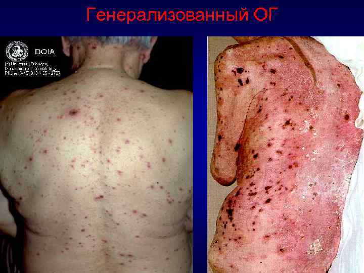 Генерализованный ОГ 