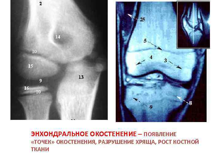 ЭНХОНДРАЛЬНОЕ ОКОСТЕНЕНИЕ – ПОЯВЛЕНИЕ «ТОЧЕК» ОКОСТЕНЕНИЯ, РАЗРУШЕНИЕ ХРЯЩА, РОСТ КОСТНОЙ ТКАНИ 