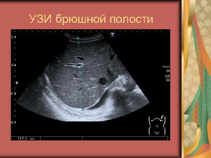 УЗИ брюшной полости 