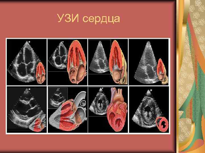 УЗИ сердца 