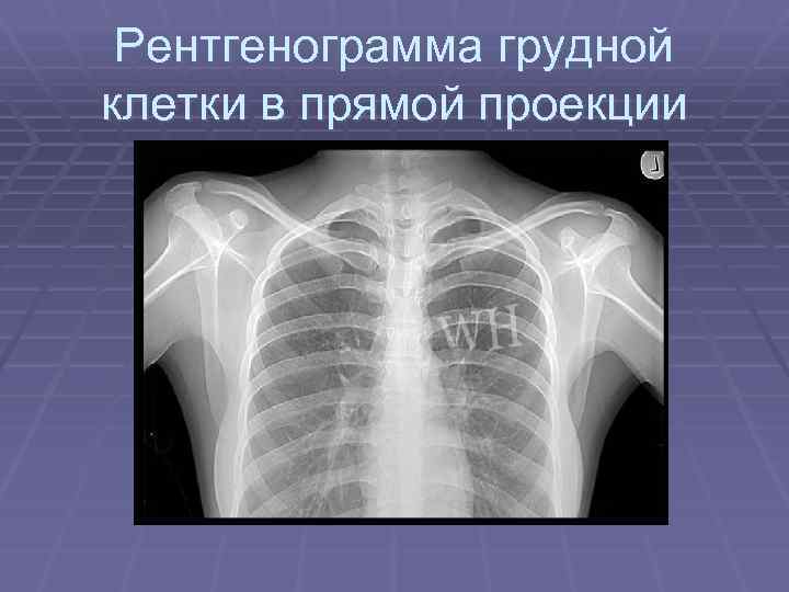Рентгенограмма грудной клетки в прямой проекции 