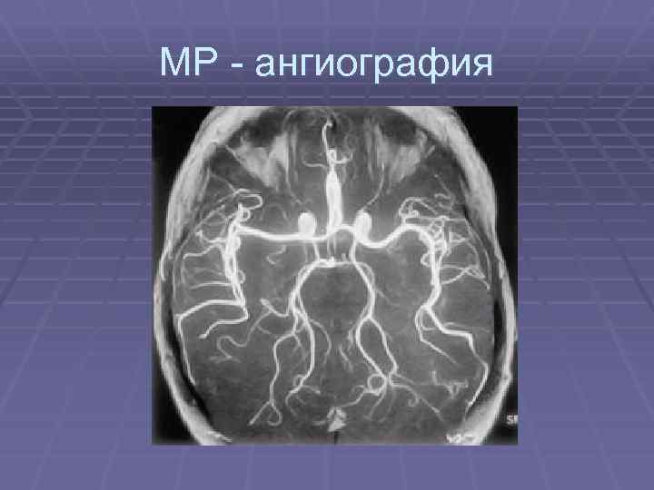 МР - ангиография 