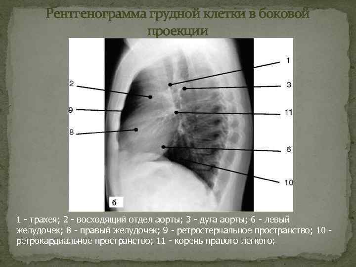 На компьютерной томограмме органов грудной клетки трахея определяется как