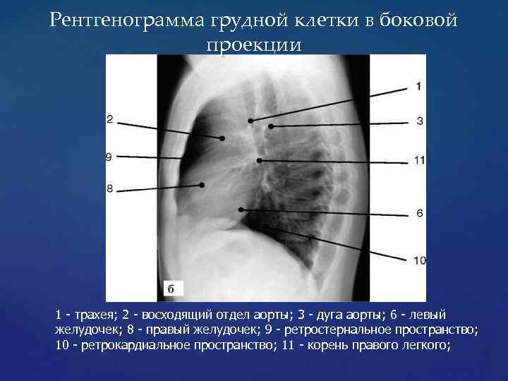 Рентгенограмма грудной клетки в боковой проекции 1 - трахея; 2 - восходящий отдел аорты;