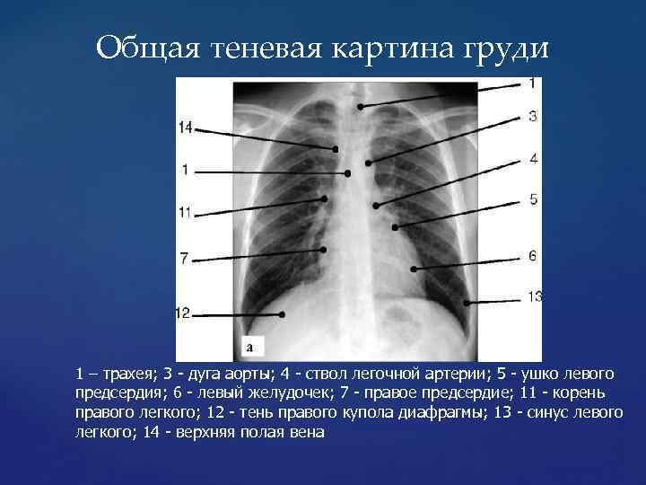 Общая теневая картина груди 1 – трахея; 3 - дуга аорты; 4 - ствол