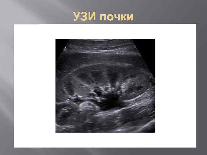 УЗИ почки 