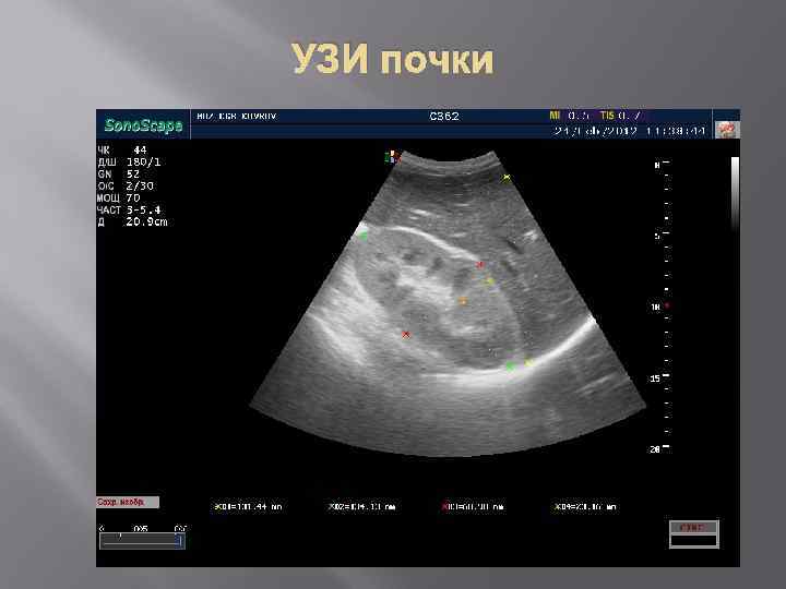 УЗИ почки 