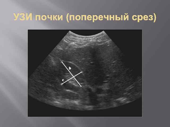 УЗИ почки (поперечный срез) 
