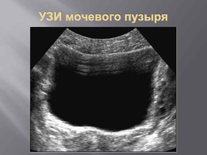 УЗИ мочевого пузыря 
