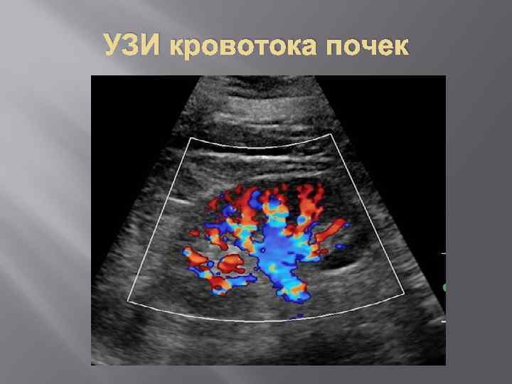 УЗИ кровотока почек 
