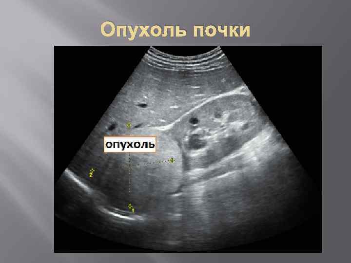 Опухоль почки 