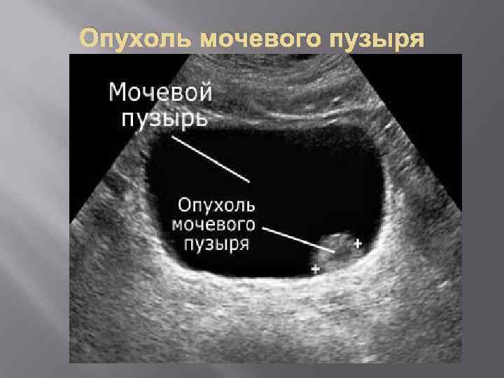 Опухоль мочевого пузыря 