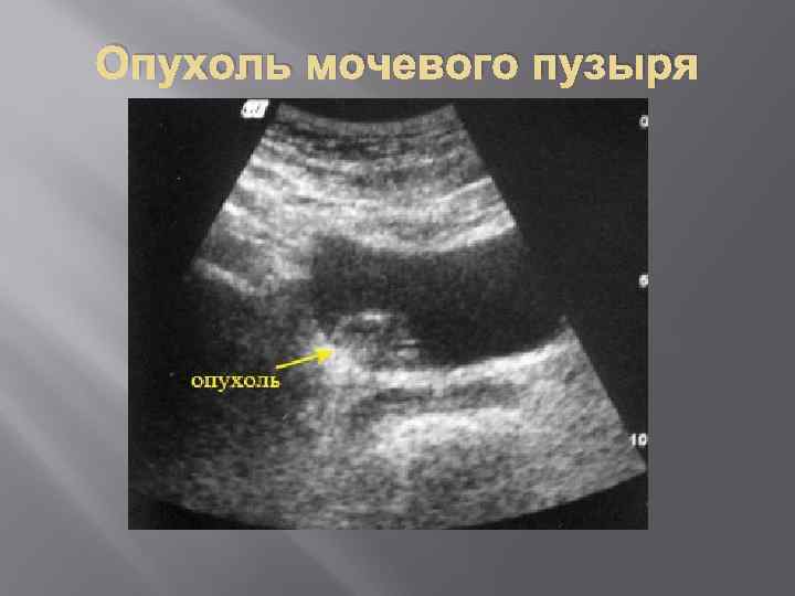 Опухоль мочевого пузыря 