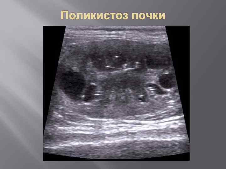 Поликистоз почки 