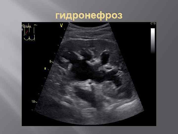 гидронефроз 