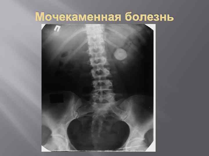 Мочекаменная болезнь 