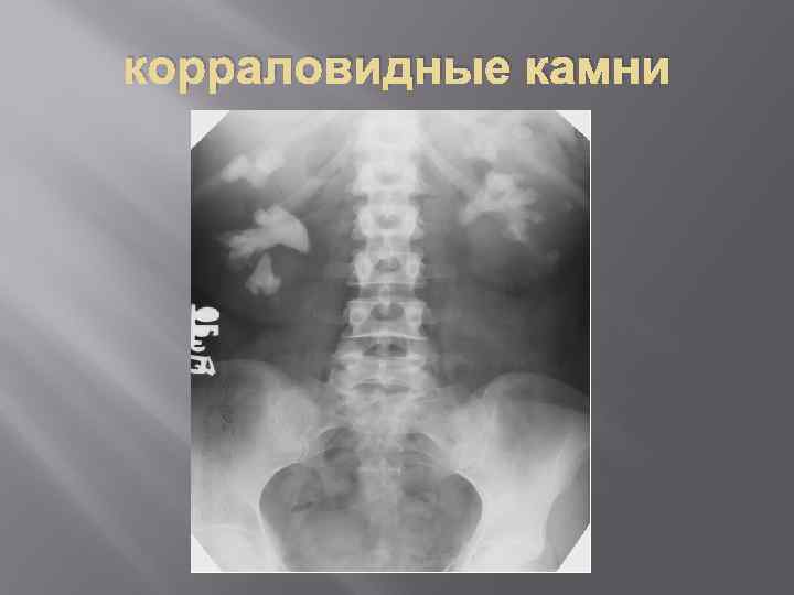 корраловидные камни 