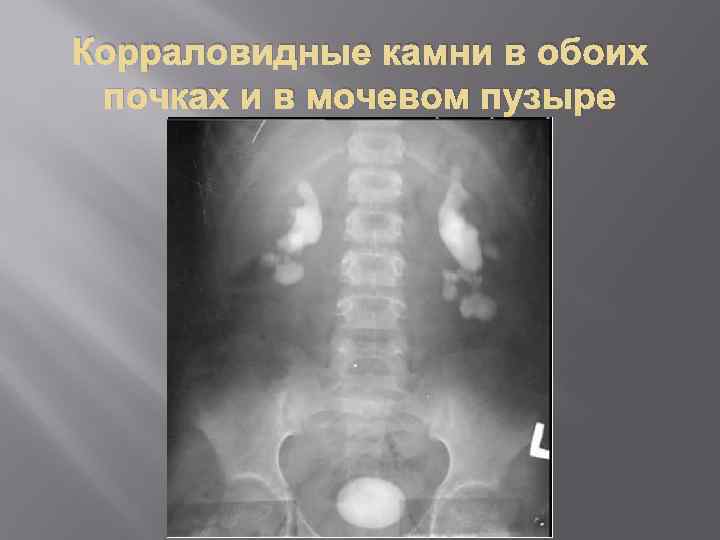 Корраловидные камни в обоих почках и в мочевом пузыре 