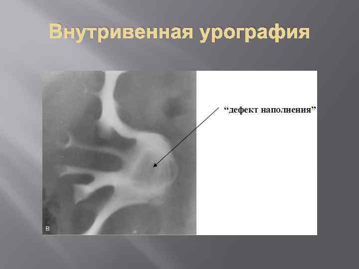 Внутривенная урография 