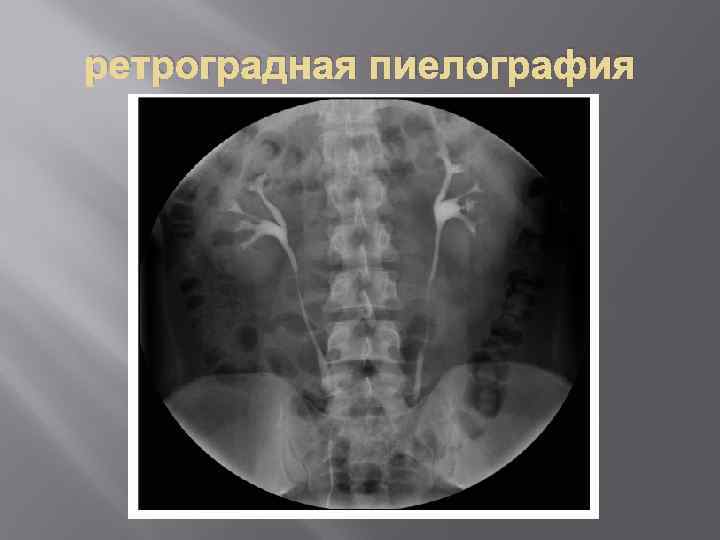 ретроградная пиелография 
