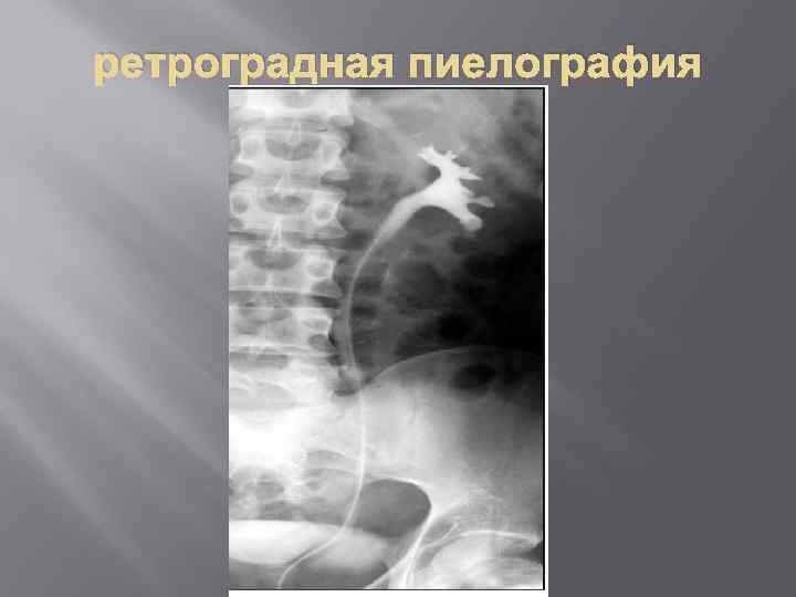 ретроградная пиелография 